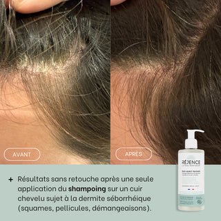 avant-apres-dermite-seborrheique-shampoing