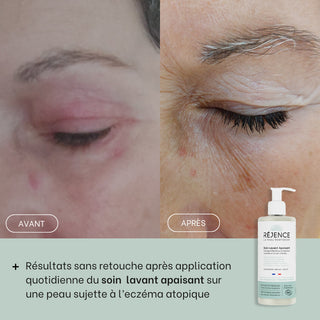 avant-apres-eczema-paupieres
