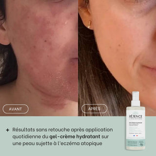 avant-apres-eczema-visage-gel-creme-hydratant